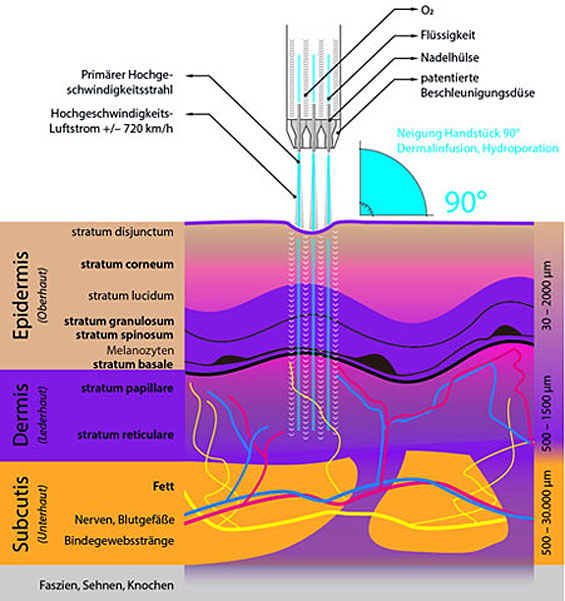 Dermalinfusion, Hydroporation